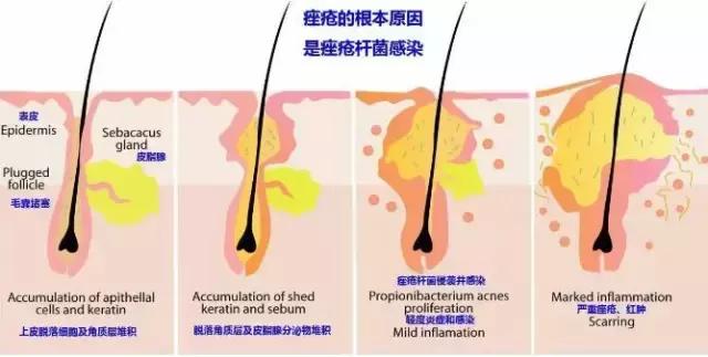 治痘好多年，方法用尽为什么还是不好？