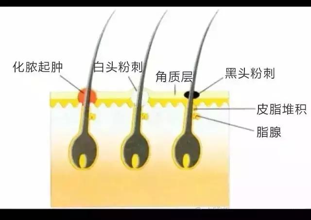 经常长粉刺是怎么回事？