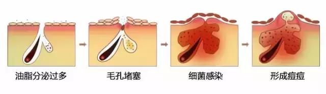 祛痘是个“技术活”，挤痘需谨慎