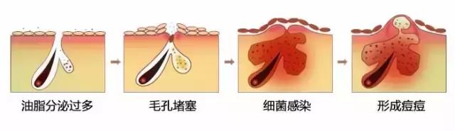 祛痘是个“技术活”，挤痘需谨慎