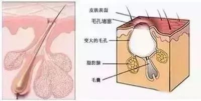 鼻子挤出白色牙膏？黑头大如草莓？知道你毛孔里的脏东西是什么吗