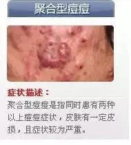 对号入座，看看你的痘痘属于哪种类型？