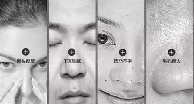 祛黑头的10个问题答案，原来你是这样的黑头