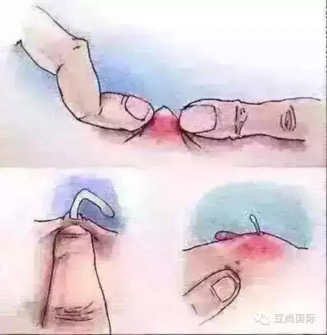 整天挤痘痘，你知道挤出来的白色东西是什么吗？