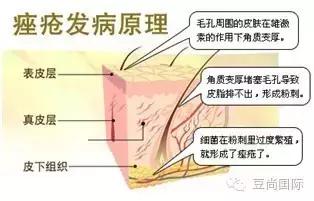 痤疮是怎么变成激素脸的？