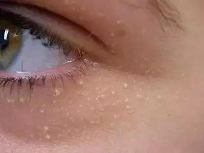 眼部“难题”脂肪粒 如何处理见效快？
