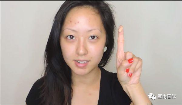治痘六妙招，让你的青春不再为痘痘发愁
