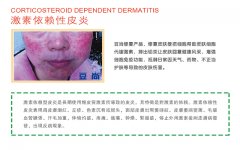 豆尚八大服务_5.激素依赖性皮炎