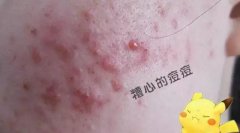 治痘好多年，方法用尽为什么还是不好？