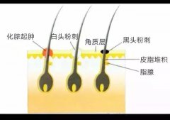 经常长粉刺是怎么回事？豆尚来支招