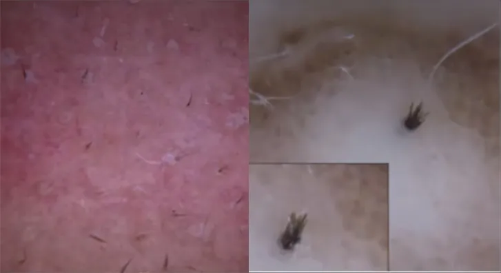 来看看你是什么类型的黑头